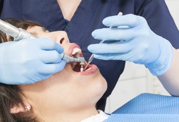 Tooth Restoration - Fillings